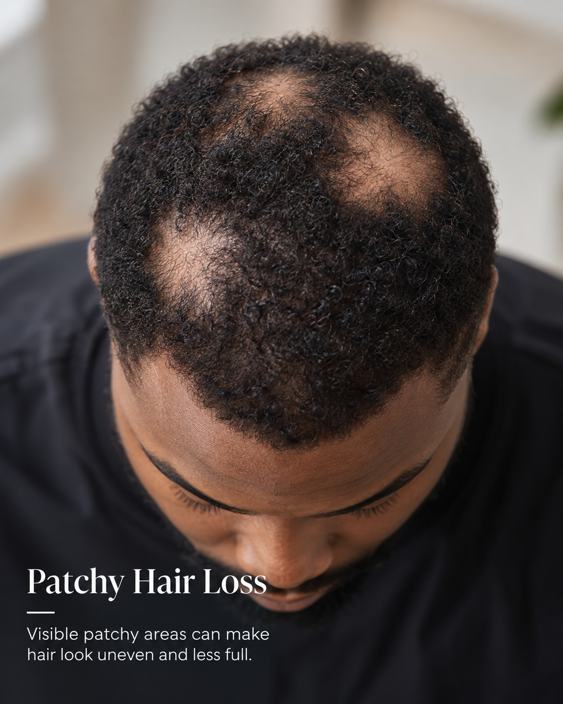 Patchy hair loss visible on scalp